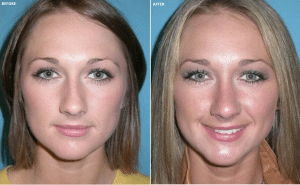 Nose job surgery before and after