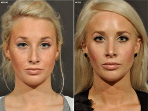 Before and after Rhinoplasty surgert