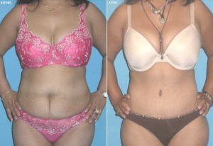 Before and after Dr. Sam Jejurikar Tummy Tuck procedure