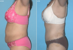 Dr. Sam Jejurikar Tummy Tuck Procedure before and after