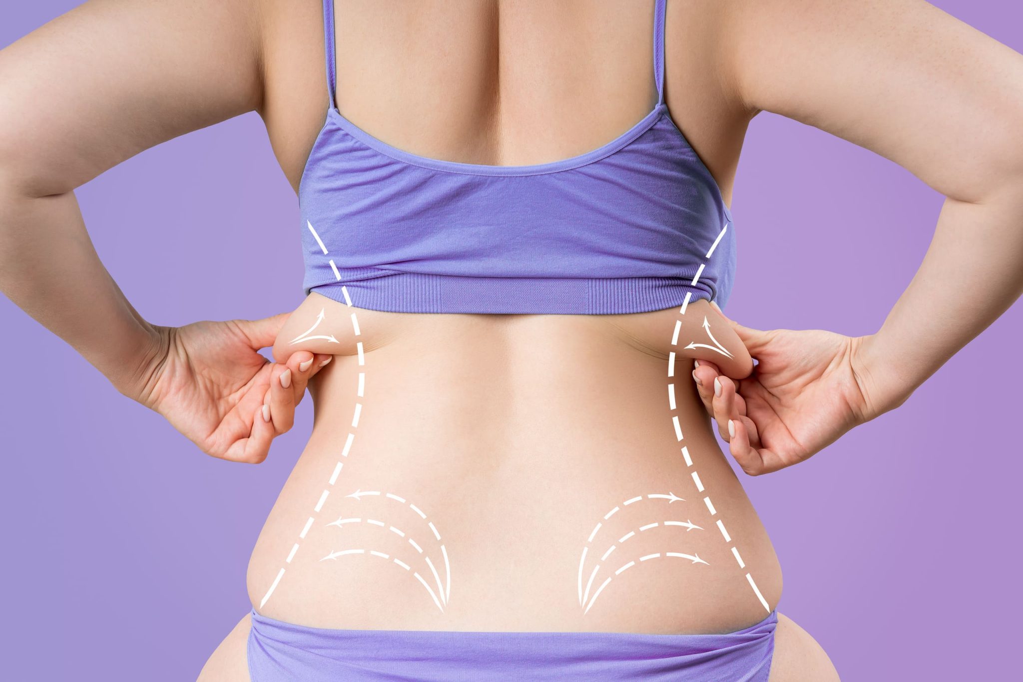 Liposuction in Dallas: Say Goodbye to Stubborn Fat