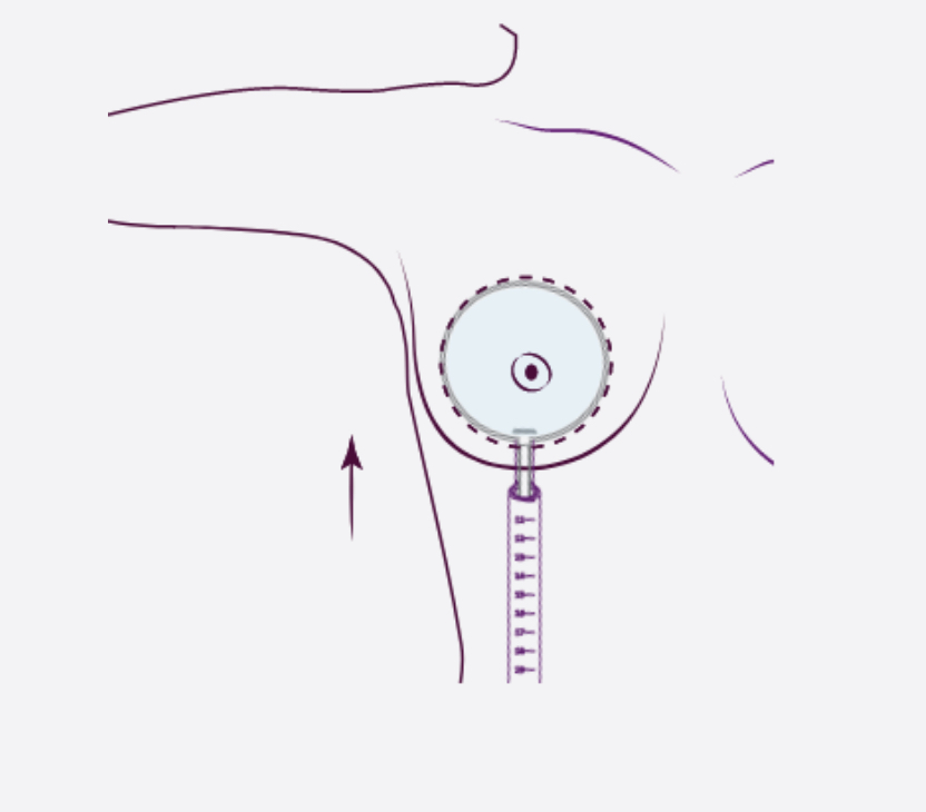 Illustration of injection technique used in atraumatic breast augmentation with Motiva system